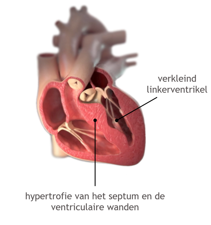 HCM - hypertrofie septum_ventrikelwand
