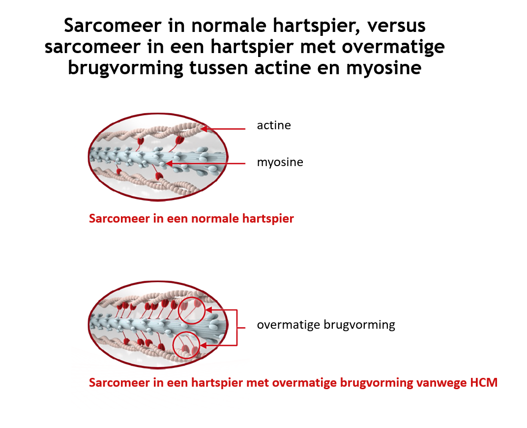Sarcomeer met overmatige brugvorming actine myos