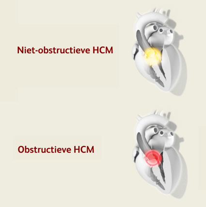 bstructieve HCM vs niet-obstructieve 